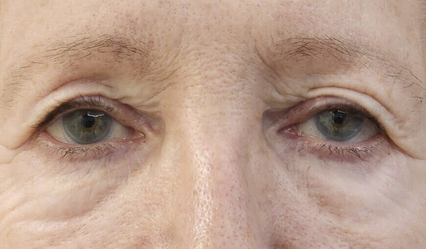 Blepharoplasty