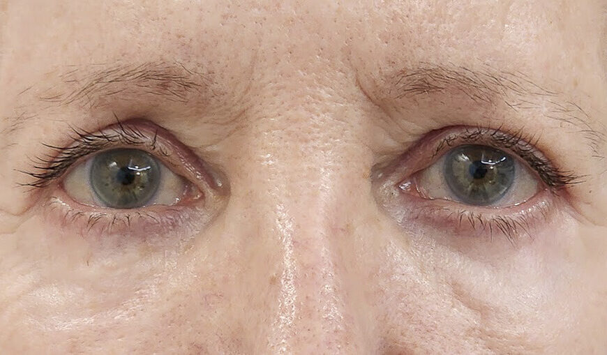 Blepharoplasty